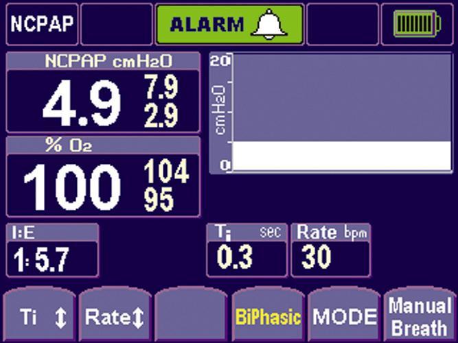 80 Infant Flow SiPAP 10. Accept the default BiPhasic settings by selecting the BiPhasic soft key again (Figure 4). Figure 4 11.