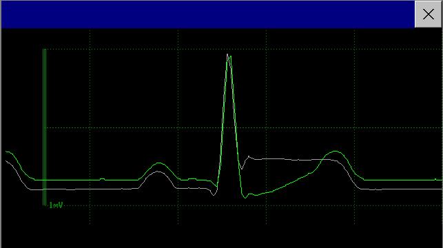 Updating ST Baseline Snippets 7 ECG, Arrhythmia, ST and QT Monitoring ST Snippets ST snippets show a one second wave segment for each measured ST lead.
