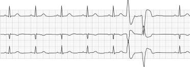 EGG BIGEMINY Bigeminy occurs when three or more bigeminal cycles (a ventricular beat followed by a non-ventricular beat) are detected.