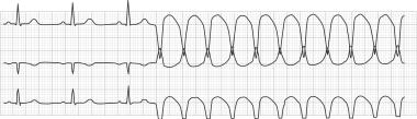 ECG VFib/VTac Ventricular fibrillation occurs when the ECG waveform indicates a chaotic ventricular rhythm.