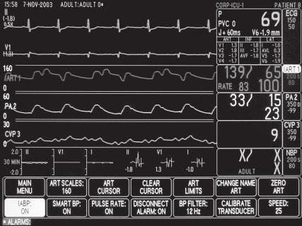 Invasive Pressures ART Parameter Window with IABP IABP (Cardiopulmonary Software Package) Triggering GE Medical Systems Information Technologies recommends that the signal source used to trigger an