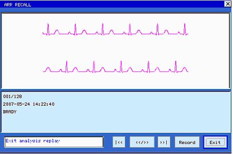 Click and open the dialog of arrhythmia review and the arrhythmia data for 8 seconds are displayed on each screen, i.e. the ECG waveforms 4 seconds before and after the occurrence of the event, and a maximum of 128 groups of abnormal data can be stored for search.