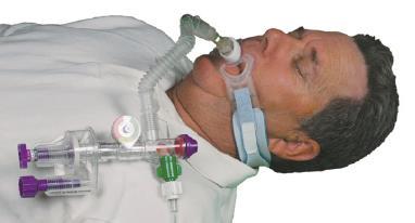 disposable ventilators are ideal for mass casualty