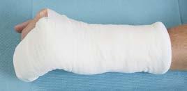 Padding over the splint to form a