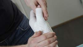 Apply the thumb splint and fold the stockinette and