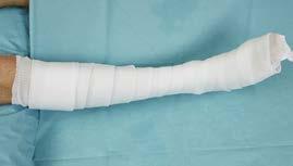 Circular Leg Cast with a dorsal Reinforcement Splint Materials Needed Stockinette 7 cm 10 cm Foam padding 7.