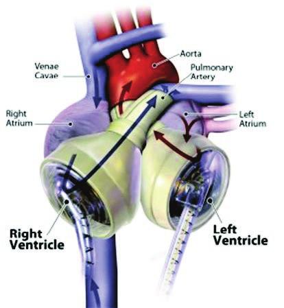 Total Artificial Heart Freedom Driver System This Patient is on an ARTIFICIAL HEART (not a left ventricular assist device-lvad) 1. Can I do external CPR? No.
