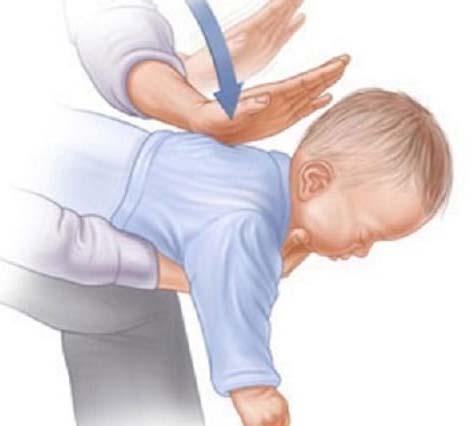Conscious Infant (under 1 year old) To dislodge an object in the airway of an infant, perform 5 Back Blows and 5 Chest Thrusts by: 1.