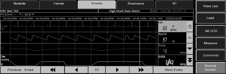Events Tab Views 7.3.4 Events Tab (Waveforms View) The Waveforms view (shown in FIGURE 7-18) of the Events tab displays waveform data for the selected patient.