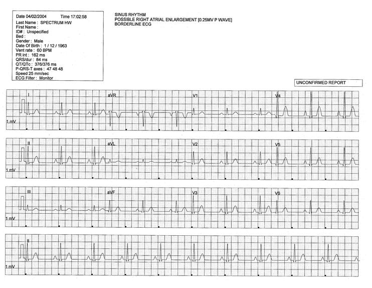 Additional Reports Report Functions 8.4.6 12-lead Report The 12-lead Report (shown in FIGURE 8-31) provides analysis of 12 vectors of ECG data for the selected patient tile.
