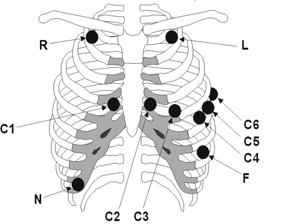 FIGURE 4-5 View 12 Card Lead Placement (AHA) Place RA (white) electrode under the right clavicle, mid-clavicular line within the rib cage frame.