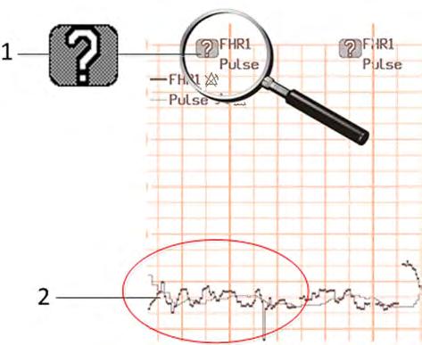 10 Cross-Channel Verification (CCV) The coincidence question mark is also printed on the trace paper next to the corresponding FHR and maternal