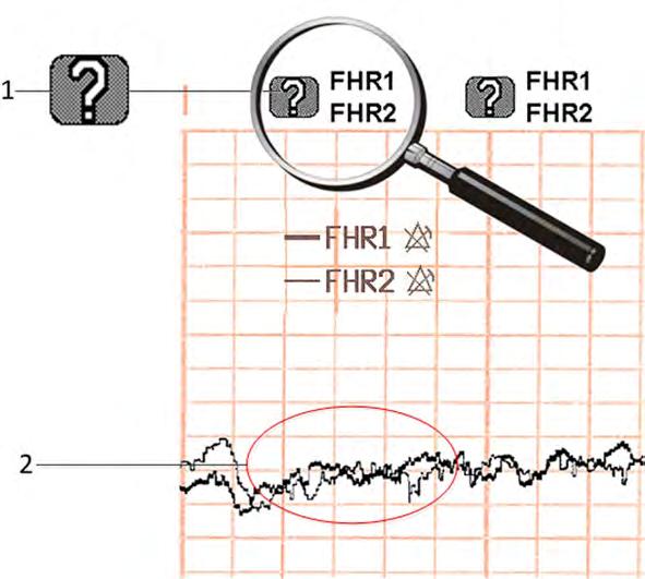 10 Cross-Channel Verification (CCV) The coincidence question mark is also printed on the trace paper next to the corresponding FHR1 and FHR2.