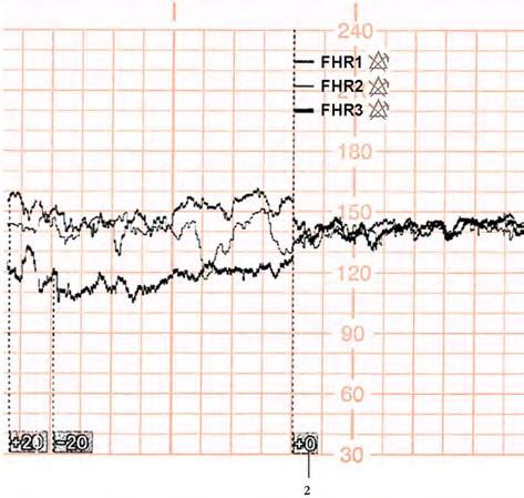 13 Monitoring Triple FHRs 2 Classic trace separation switched off here Troubleshooting Common problems that may occur when monitoring FHR using ultrasound are listed in Monitoring FHR and FMP Using