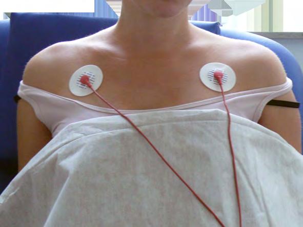 21 Monitoring Maternal Heart / Pulse Rate Applying Electrodes To derive the MHR (when you do not want to view the MECG waveform), you can place the electrodes just below the outer end of the clavicle