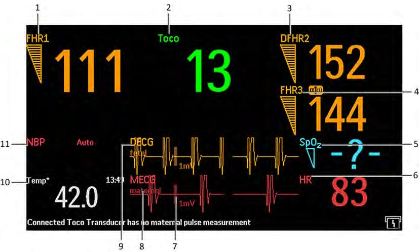 21 Monitoring Maternal Heart / Pulse Rate Viewing the Waveform on the Screen 1 Measurement label (FHR1) 2 Measurement label (Toco) 3 Measurement label (DFHR3) 4 Measurement label (FHR1) 5 Measurement