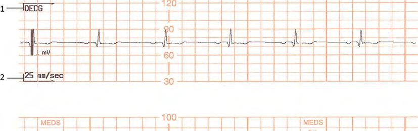 22 Printing the ECG Waveform 22Printing the ECG Waveform FM30/50 You can print the ECG wave onto the trace paper. If you are monitoring both DECG and MECG, both waves will be printed.
