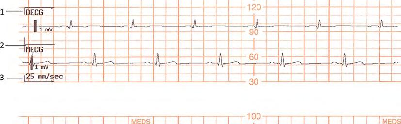 ECG wave: Separate: This recording mode gives you a six-second ECG strip on the fetal trace paper