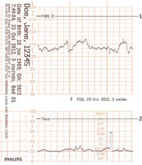 3 Basic Operation the Recorder Speed 1 Fetal heart rate label 2 Uterine activity label The current monitoring modes (if any transducers are connected to the monitor) are printed.