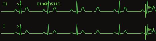 10.3 ECG Display 10.3.1 ECG Waveform In the standard screen, one or two ECG waveform(s) is (are) displayed at the top of the display when LEAD TYPE is set to 3 LEADS or 5LEADS respectively in the ECG SETUP menu.