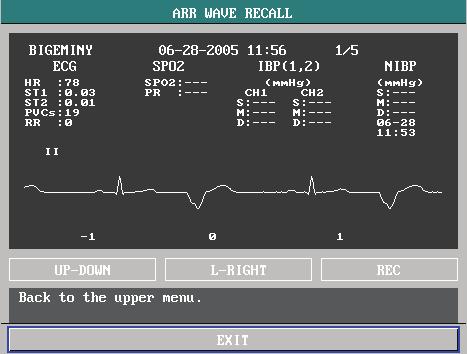 You can perform the following operations: Figure 10-19 Arrhythmia waveform Review UP-DOWN This option allows you to page up and down to review the waveform and the parameters of other arrhythmia
