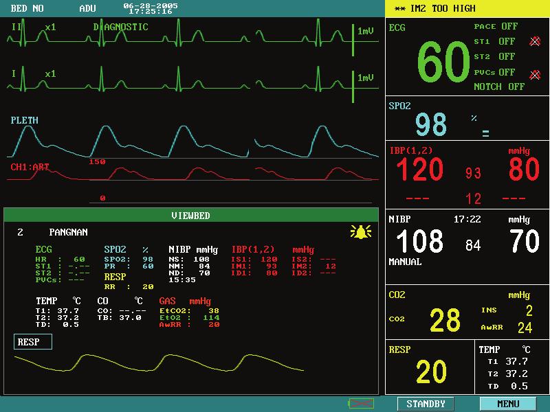 5.4 Viewbed Screen This monitor can view one parameter waveform and measured data from another patient monitor (viewbed monitor) on the same monitoring network.