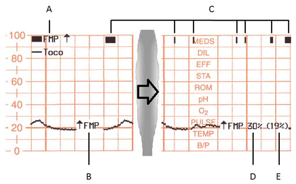 5 Measurement Settings FMP can be enabled from any FHR channel, even though the fetal movement detection itself only applies to FHR1.