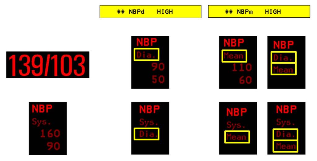 5 Measurement Settings Alarms from Dia & Mean Sys & Mean Sys&Dia&Mean Issued Alarm NBPm High NBPm High NBPm High Sys. High, Sys. Low, Dia. High, Dia.