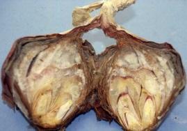 Onion neck rot Infection can also occur at harvest if the necks