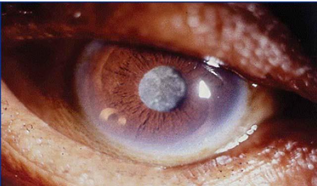 4 μm) Corena Cateract from UV exposure Regular eye exams important