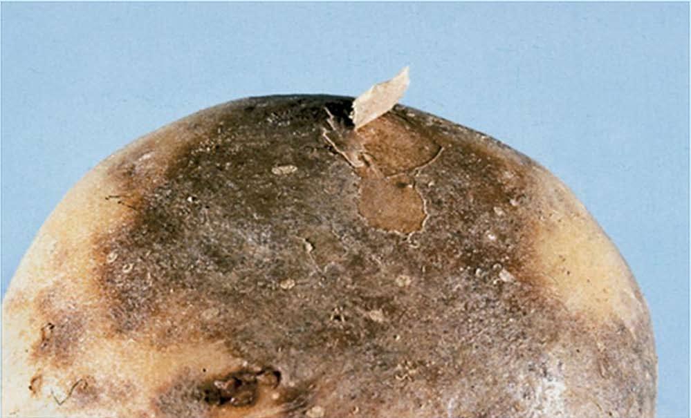Figure 1: Silver scurf lesions are circular, are tan to gray when young and later develop a silver appearance.