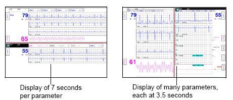 The number of waveforms displayed per patient depends on the number of patients that you choose to display: the more patients you display, the less room is available on your screen for display of