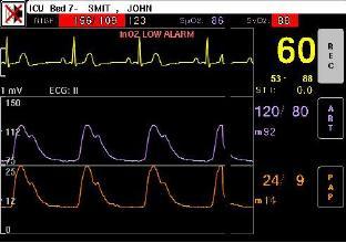 Using the Multi-Bed Screen Figure 3-7: Waveform Order Panel The vital signs displayed for each patient are those defined at each bedside monitor, according the defined parameter hierarchy.