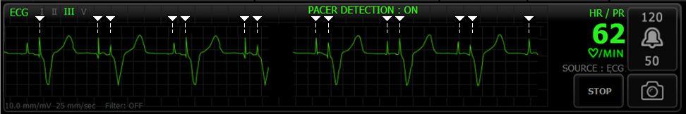 Directions for use Patient monitoring 181 3. Touch the ECG vertical tab. 4. Adjust the following settings as desired: ECG Gain. Select the desired gain. Sweep speed.