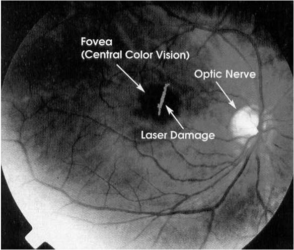 Eye Hazards Simplified Schematic of the Human Eye Sclera Ciliary muscle Choroid Cornea Iris Retina Fovea Visual axis Aqueous humor Lens Optic nerve