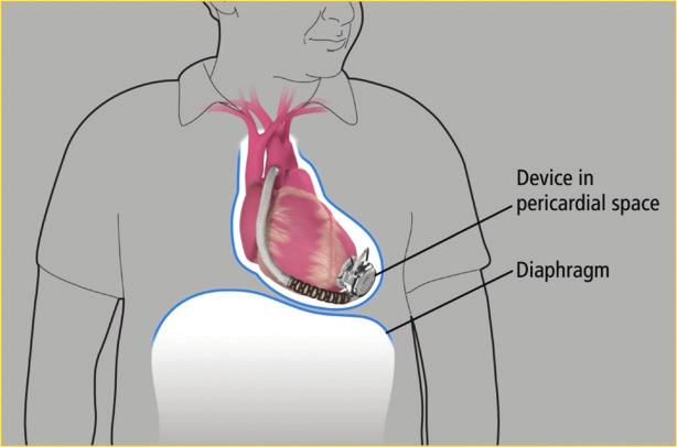 HVAD Patient Manual 2.4 The Operation to Place the HeartWare HVAD System Placement of the HeartWare HVAD System requires a major operation.