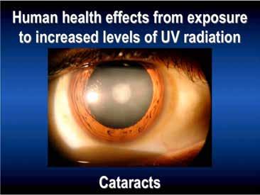 Cataracts cloud the lens of the eye, thus limiting vision.