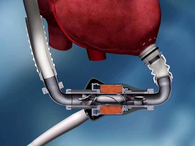 Heartmate II Flexible inflow conduit Textured surfaces Inlet cannula, inflow and outflow elbows Thrombo-resistant Outflow graft with bend