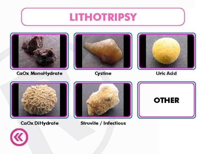 5.2.3 Lithotripsy Mode: If you select Lithotripsy in the first mode emission selection (cap5.2.2) the following screen will appear: Select the Type of stone to treat: - CaOx MonoHydrate -