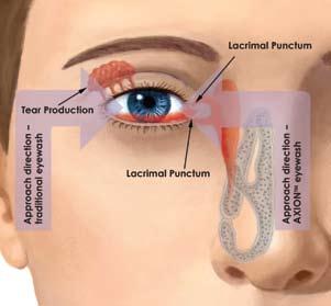 The medical profession teaches and practices irrigating eyes by introducing flushing fluid at the inner corner of the eye adjacent to the nose letting it run across the eye to the outer edge.