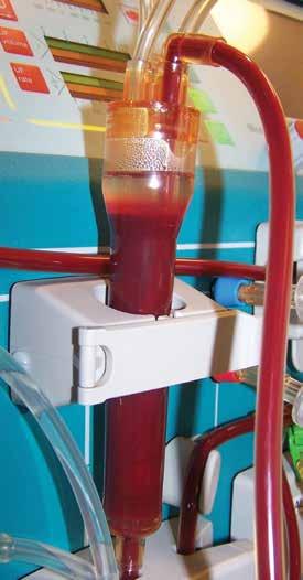 Kidney Dialysis Machines Kidney dialysis machine treatments replace some kidney functions by removing waste and fluid from the bloodstream via diffusion and osmosis of solutes and fluid across a