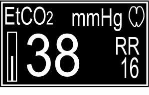 EtCO 2 NUMERIC SECTION Figure 18: EtCO 2 Numeric In the model 9405, this section displays the numeric values for both EtCO 2 and Respiration Rate and a flashing visual icon for the Respiration Rate.