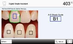 are automatically recognized. The software compares the tooth to be analyzed with the reference teeth.