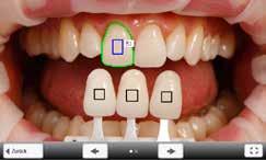 7. Verifying the designations (correcting) If the designations of the shade guide teeth cannot be clearly recognized, this screen is shown.