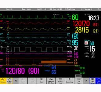 Alarm Parameters Anesthesia Monitor Alarms