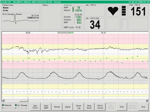 Data Presentation Windows Live EFM Window This is the window you normally use when monitoring. FECG Signal Window When monitoring with scalp electrode, use this window to inspect the fetal ECG signal.
