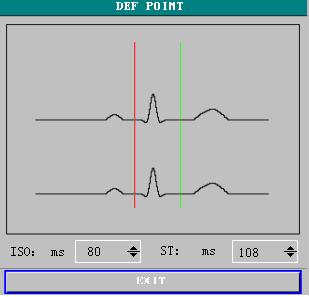 Picture 8-7 Decide ST Segment Analysis Point Attention If HR or ECG waveform of the patient has obvious changes, ST measuring point is required to make adjustment.