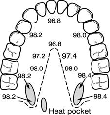 To take an accurate oral temperature reading, place the thermometer tip in either the right or left posterior pocket (heat pocket) at the base of the tongue. 4.