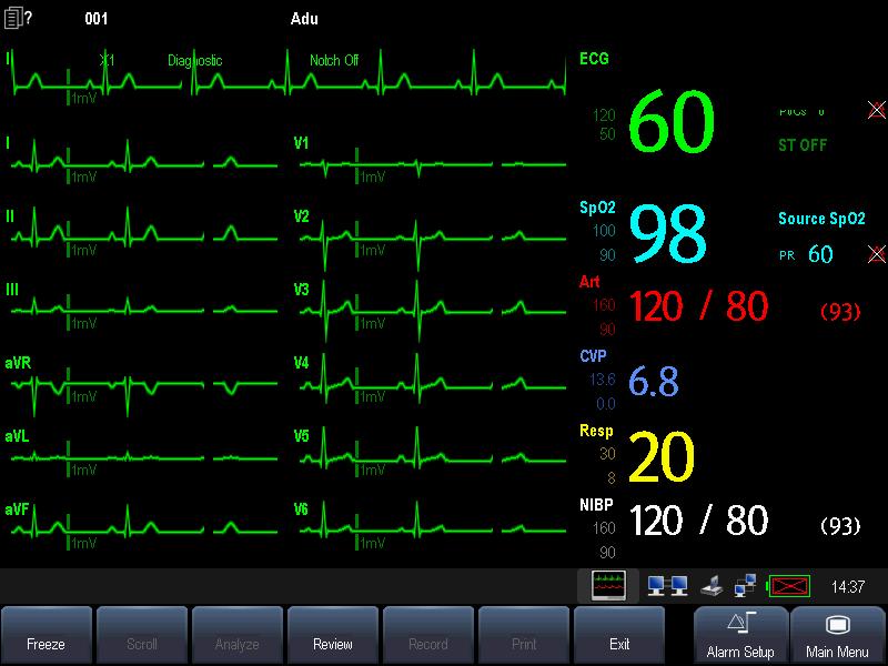 7.8 12-Lead ECG Monitoring Entering the 12-lead ECG Monitoring Screen 1. Refer to the section 7.3.3 ECG Lead Placements for placing the electrodes. 2.