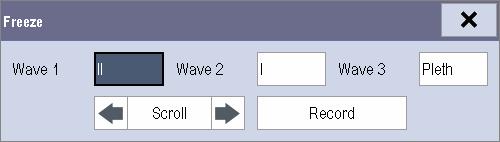 21 Freezing Waveforms During patient monitoring, the freeze feature allows you to freeze the currently displayed waveforms on the screen so that you can have a close examination of the patient s